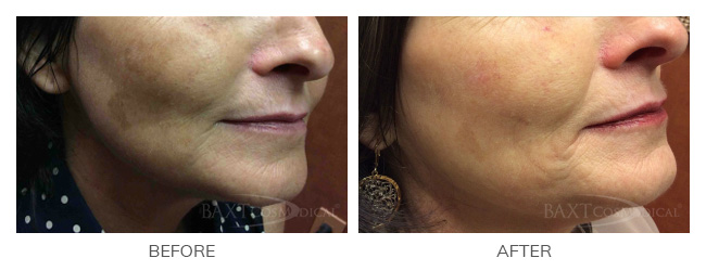 Click Here to View Chemical Peels Before & After Photos