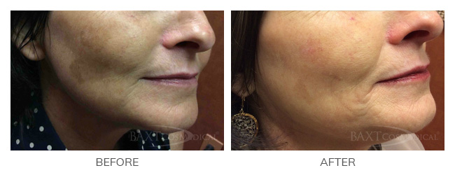 Click Here to View Chemical Peels Before & After Photos Click Here to View Chemical Peels Before & After Photos