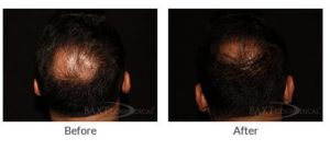Hair loss treated by PRP