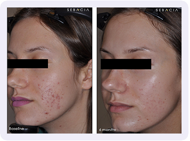 Acne Treatment Special Acne Treatment Special