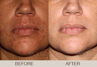 Acne Treatment Gallery