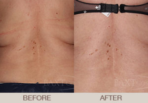 CoolSculpting® Gallery