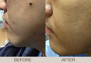 Mole & Lesion Removal Gallery