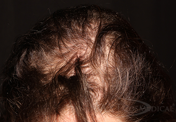 Before PRP Hair Restoration