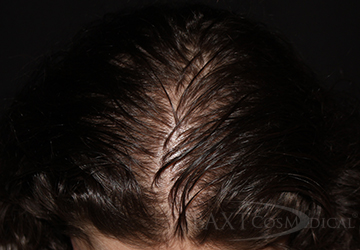 After PRP Hair Restoration