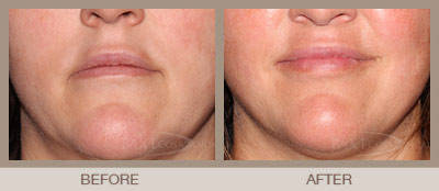 Restylane Kysse Before and After Treatment