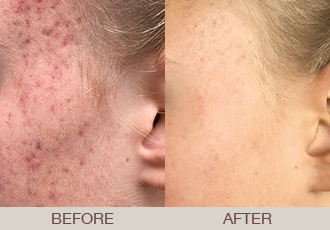 Medication & Chemical Peel Before & After Photos Bergen County