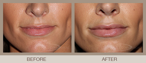 Lip Volume Filler Bergen County