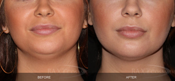 Kybella® Before & After Photos Bergen County