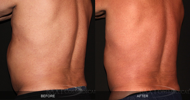 CoolSculpting® Before & After Photos Bergen County