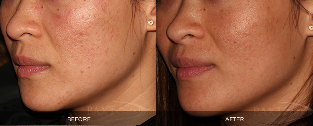 Acne Treatment Before & After Photos Bergen County