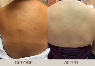 Acne Treatment Gallery