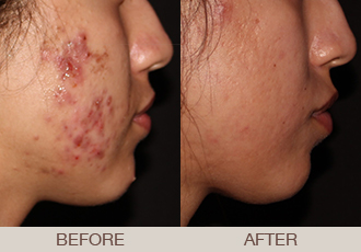 Acne Treatment Gallery