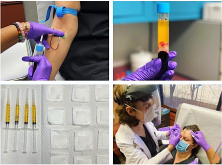 Dr. Rebecca Baxt prepares PRP injection Dr. Rebecca Baxt prepares PRP injection