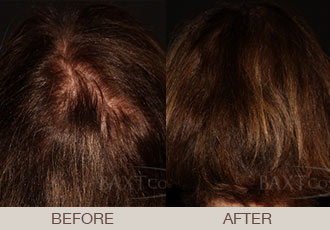 Hair Restoration (PRP) Before & After Photos Bergen County Hair Restoration (PRP) Before & After Photos Bergen County