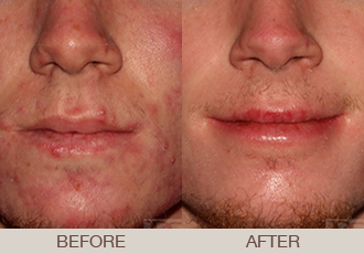 Acne Treatment Gallery