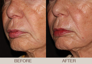 Fraxel® Dual Laser Resurfacing