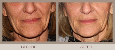 Liquid Facelift Bergen County