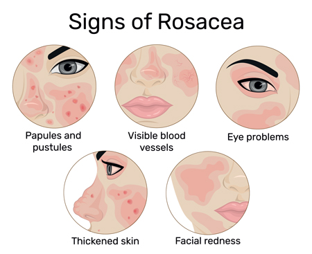 Rosacea Treatments Bergen County