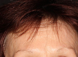 BOTOX® Cosmetic Before and After - Paramus, NJ