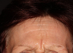 BOTOX® Cosmetic Before and After - Paramus, NJ