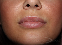 BOTOX® Cosmetic Before and After - Paramus, NJ