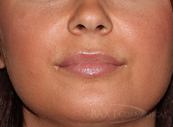 BOTOX® Cosmetic Before and After - Paramus, NJ