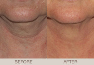 CoolSculpting® Gallery