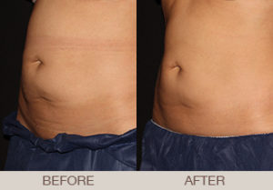 CoolSculpting® Gallery