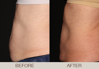 CoolSculpting® Gallery