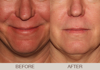 Click Here to View More Photofacial Before & After Photos