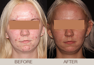 Acne Treatment Gallery