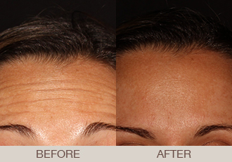 Click Here to View More BOTOX® Before & After Photos