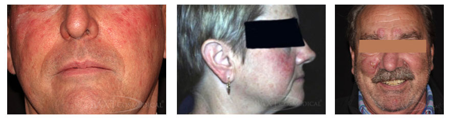 Dr. Baxt's Rosacea Patients