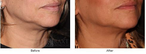 Ultherapy  Before and After