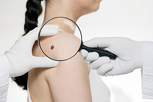 Woman with a mystery mole on shoulder
