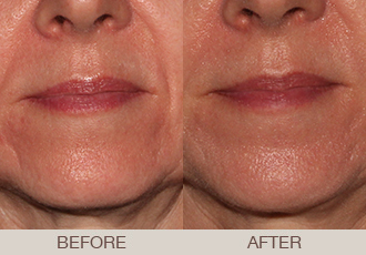 Click Here to View More Filler Before & After Photos
