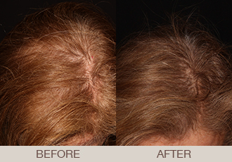 Non-Surgical Hair Restoration Bergen County - Paramus, New Jersey