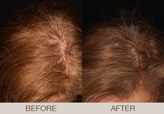 Hair Restoration (PRP) Before & After Photos Bergen County