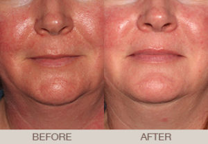 Rosacea Treatment Gallery