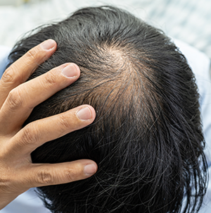 Example of Male-pattern baldness