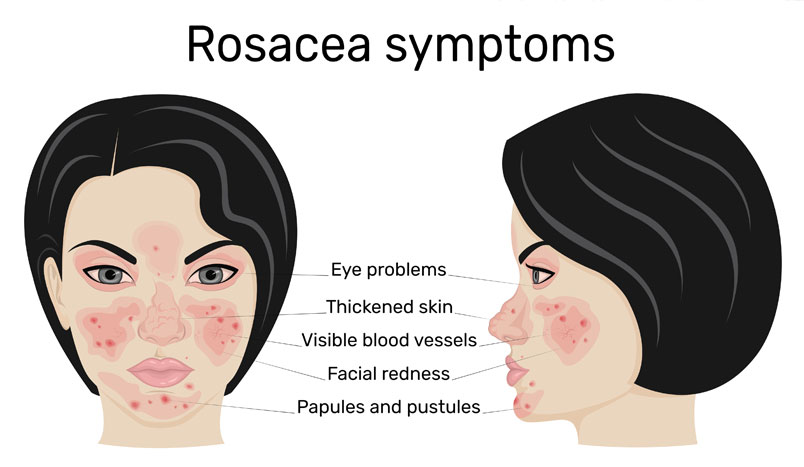 Rosacea Symptoms