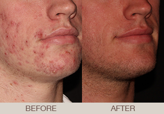 Acne Treatment Gallery