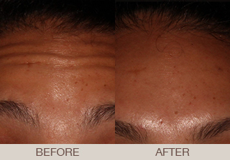 BOTOX<sup>®</sup> Cosmetic Gallery