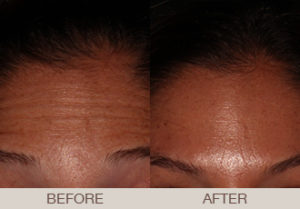 BOTOX<sup>®</sup> Cosmetic Gallery