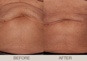 CoolSculpting® Gallery