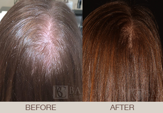 Hair Restoration (PRP) Before & After Photos Bergen County