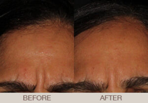 BOTOX<sup>®</sup> Cosmetic Gallery