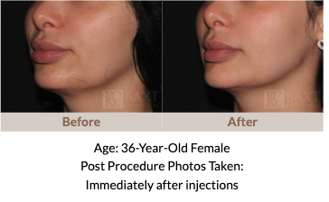 Before and After Juvederm® Volux