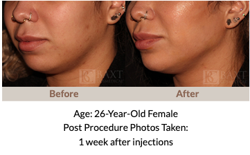 Before and After Juvederm® Volux Example